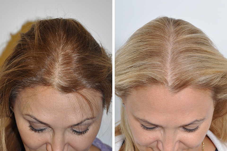 Hair Transplant Turkey – Professional and Affordable Services