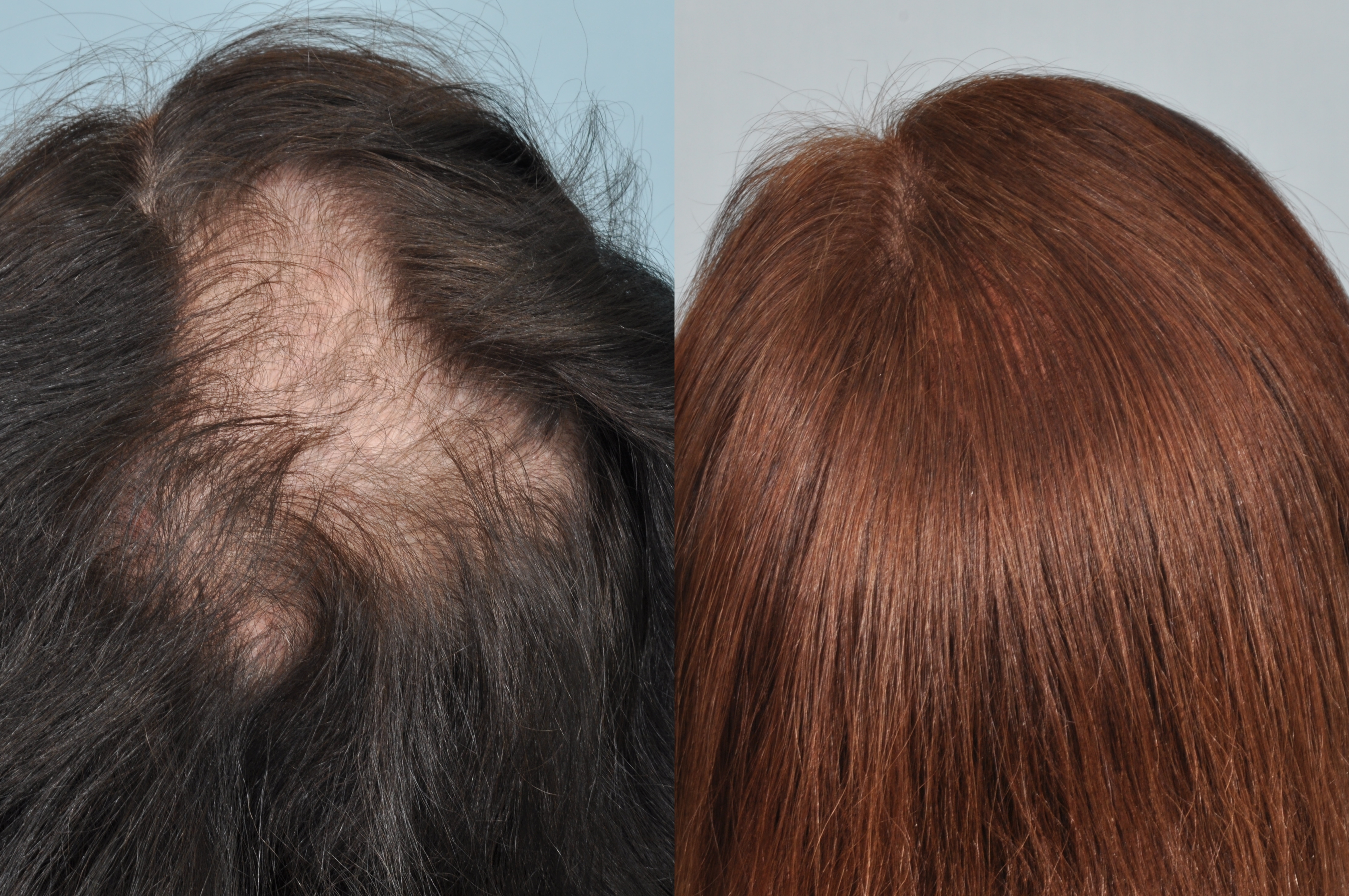 Your Complete Guide to Hair Transplant London Procedures